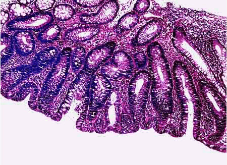 肛门有个紫色血泡照片图片