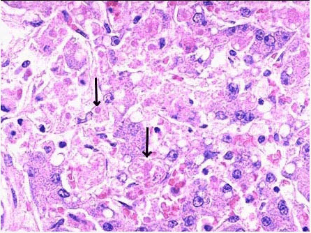 肝细胞水肿镜下观图片