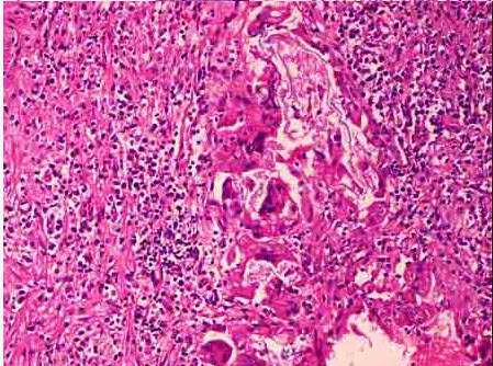 異物肉芽腫d: 機化e肛門旁邊皮下硬塊圖片纖維素性炎表皮樣囊腫病理