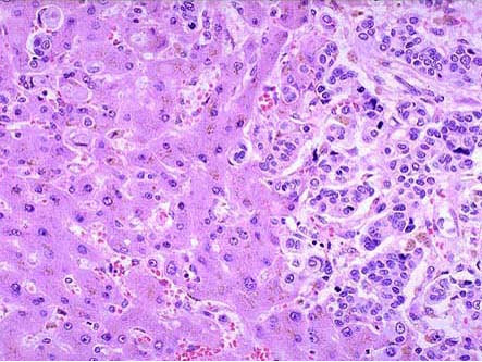 死者女性76岁死于晚期胃癌恶病质尸检见肝脏表面多发性边界清楚结节