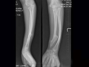 12岁女性患者,左前臂外翻畸形4年,摄片如图所示,最佳的诊断是()