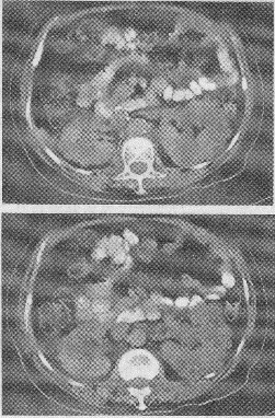 双肾ct平扫图像如下,符合下列何种疾病()