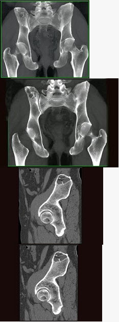 右侧髂骨疼图片