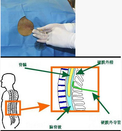 硬膜外麻醉侧入法图谱图片