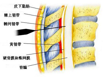 硬膜下间隙图片