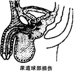 骑跨性尿道损伤,不能自行排尿且有尿外渗.尿外渗的范围多见于)