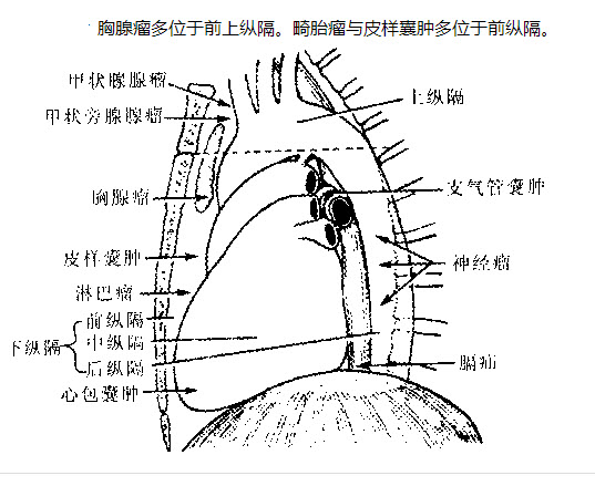 胸腺瘤的位置图图片