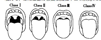 关于改良的mallampati气道分级评定根据图形进行判断正确的是